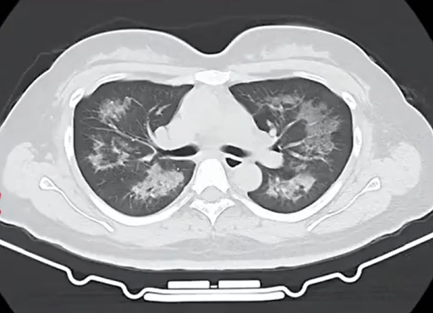 每天用2次,22岁女主播肺里长满阴影!很多人不注意